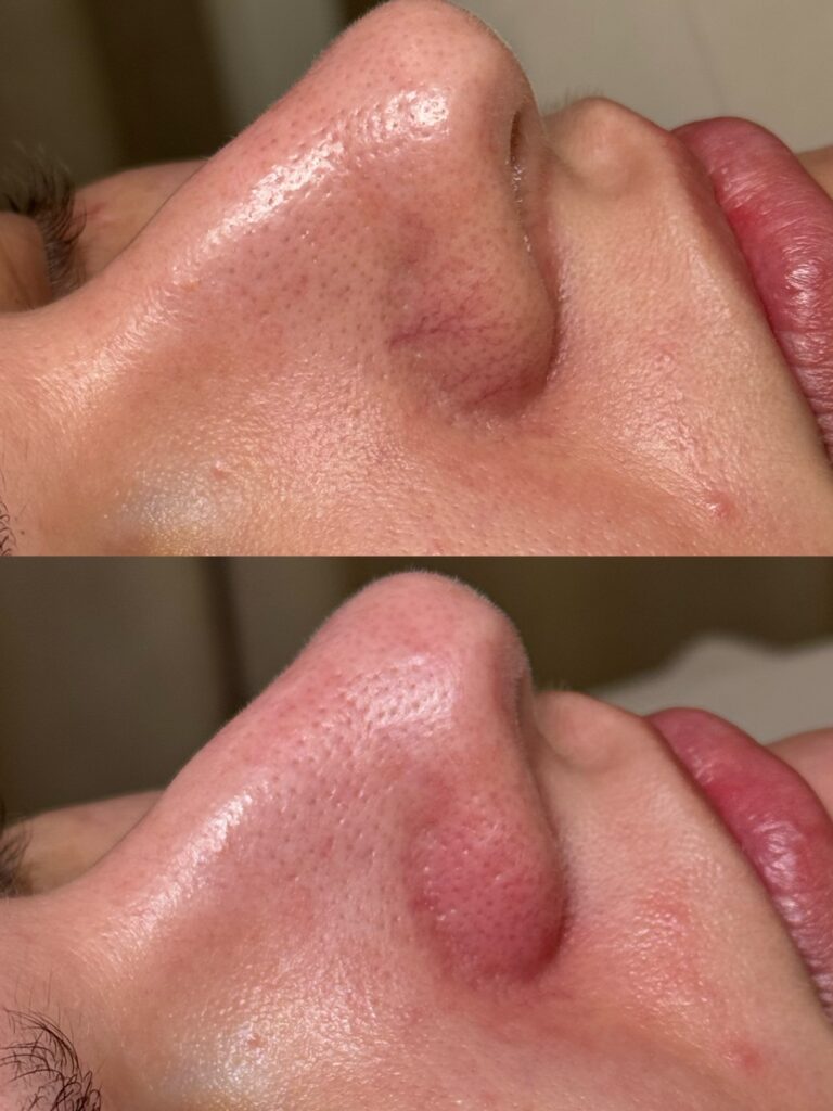 efekty zabiegu laserowego na twarz redukcja rumienia i naczynek