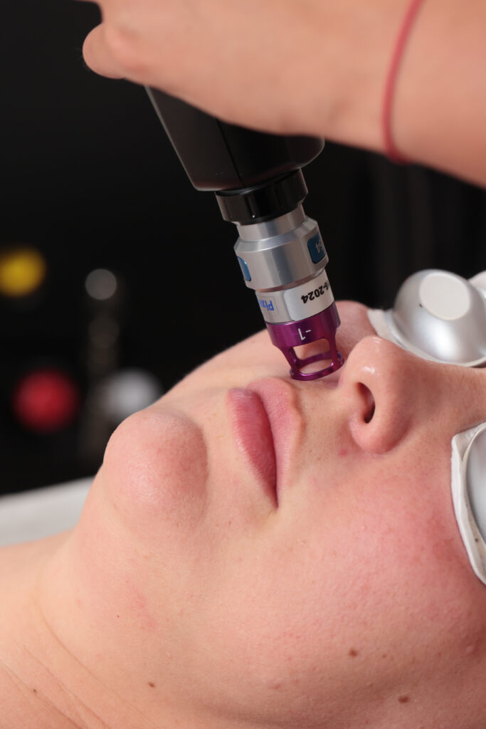 cera naczynkowa zaczerwieniona skóra twarzy problem rumienia