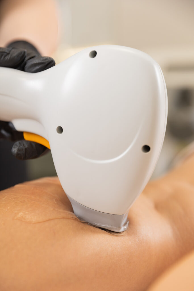 epilacja laserowa zabieg w klinice – czy epilacja laserowa boli