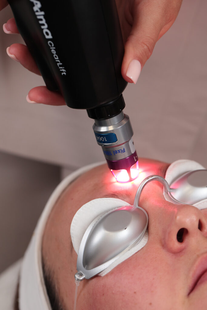 przebarwienia na twarzy nierówny koloryt skóry jak się ich pozbyć